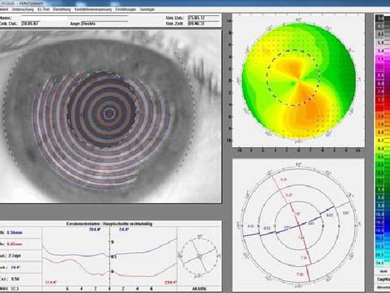 keratographenmessung